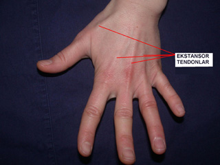 ekstansor-tendon2